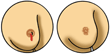 early symptoms of Breast Cancer